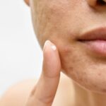 Trends in Sustained-Release Formulations for Acne and Psoriasis