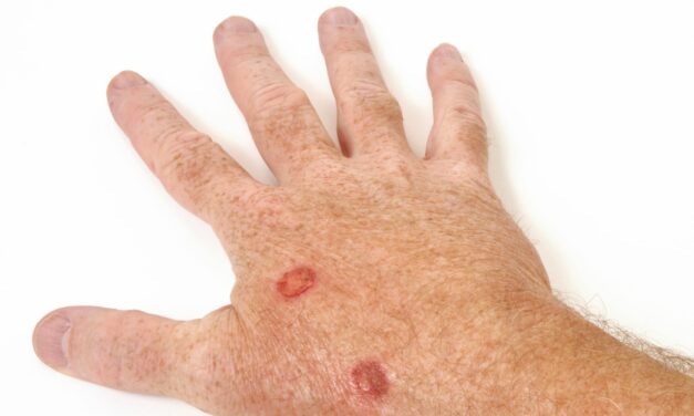 Efficacy of Cryotherapy in Treating Actinic Keratosis: A Comprehensive Review
