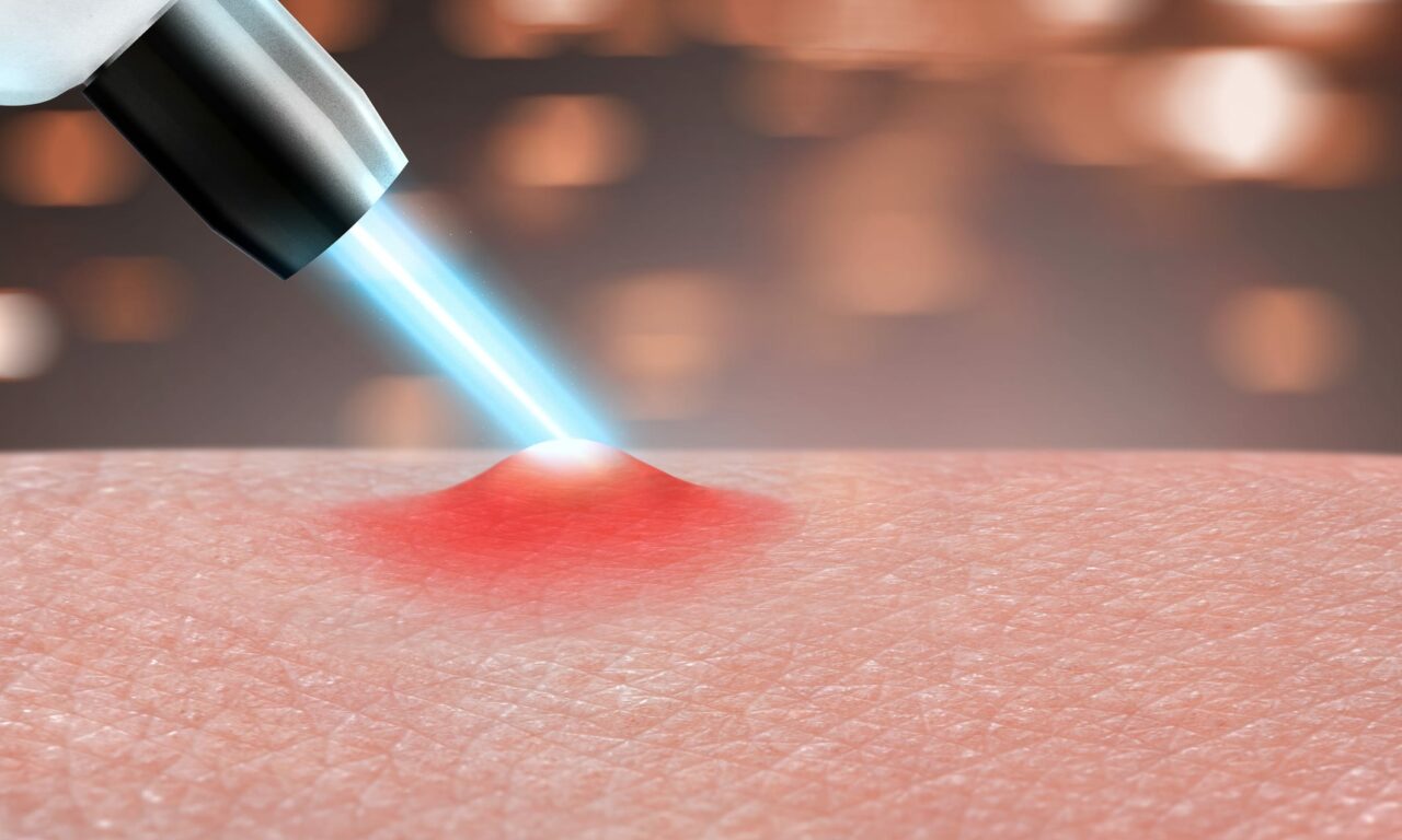 Laser and Light Therapies: Innovations in Treating Chronic Skin Conditions