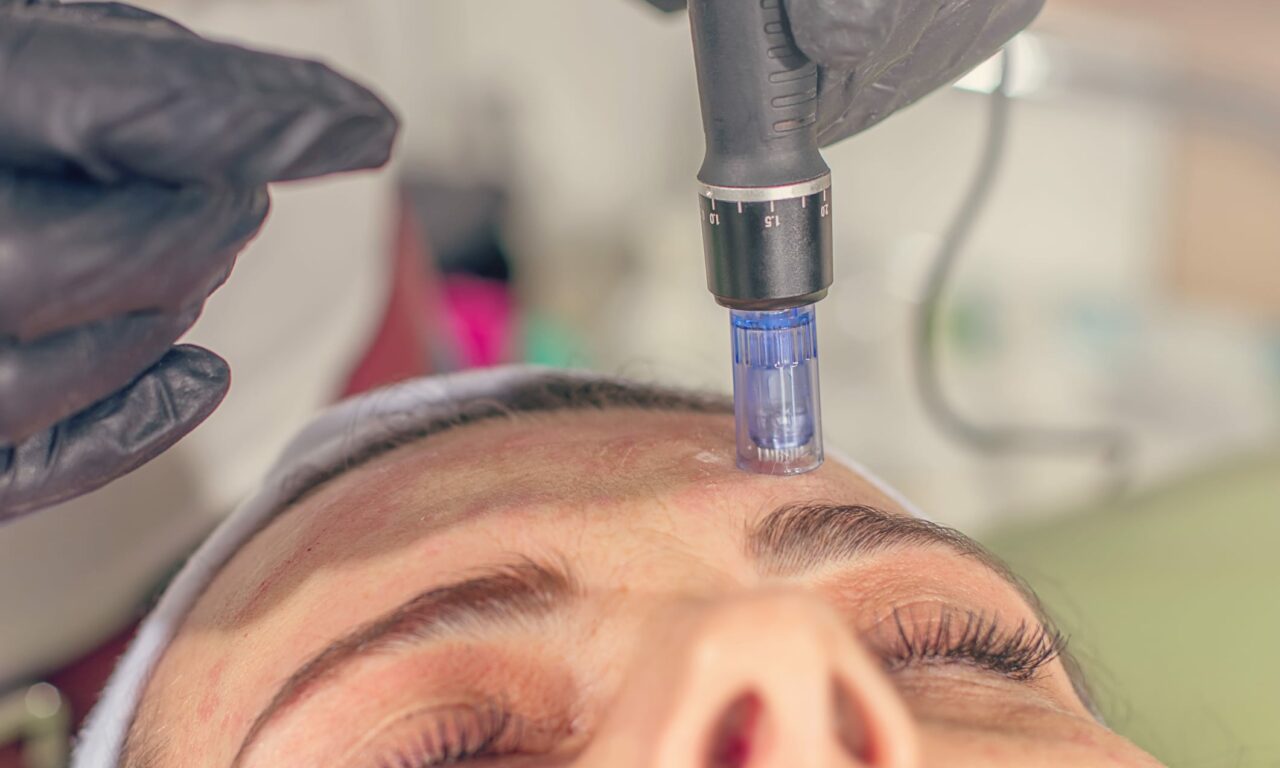 Dermatologists Embrace Microneedling with Radiofrequency for Advanced Skin Treatments