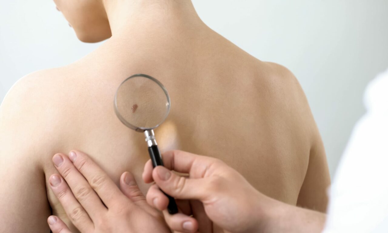 Exploring New Oral Chemotherapy in Skin Cancer Treatment