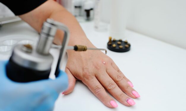 Comparative Efficacy of Cryotherapy Versus Other Modalities in Wart Treatment