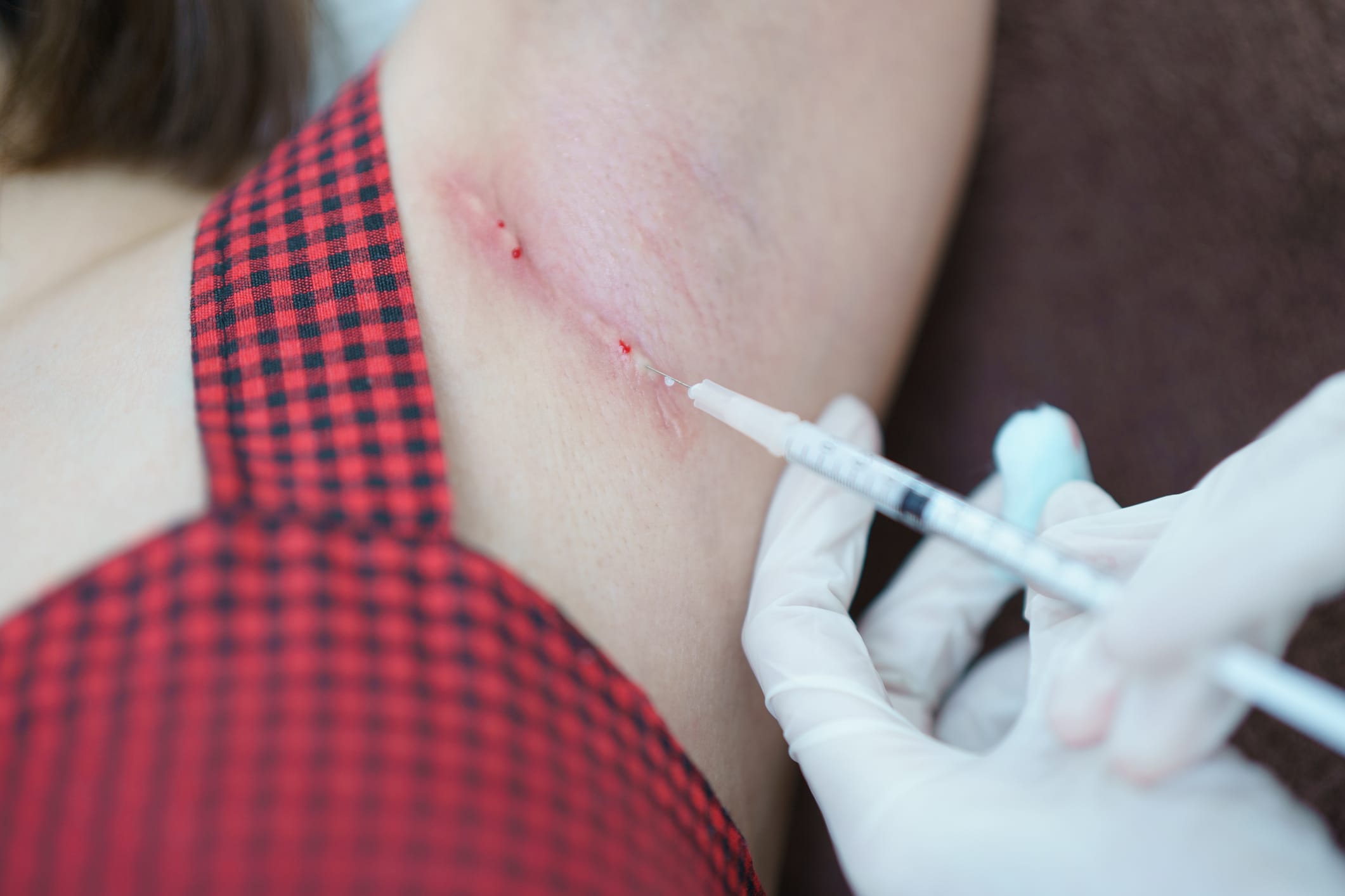 Therapeutic Injectables for Skin Conditions in Dermatology